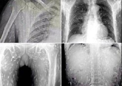 x-ray of Chinese Man's Body Riddled With Tapeworms