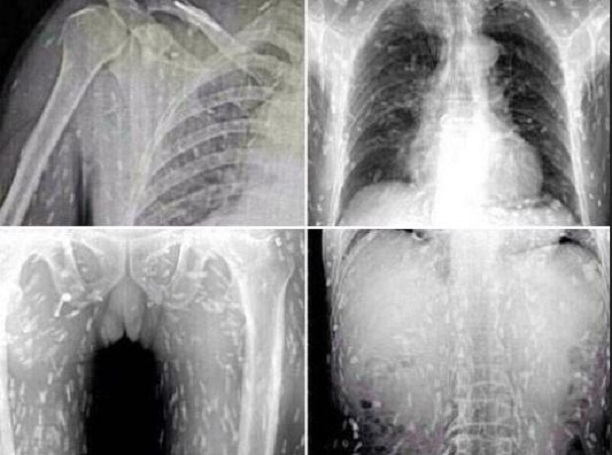 x-ray of Chinese Man's Body Riddled With Tapeworms